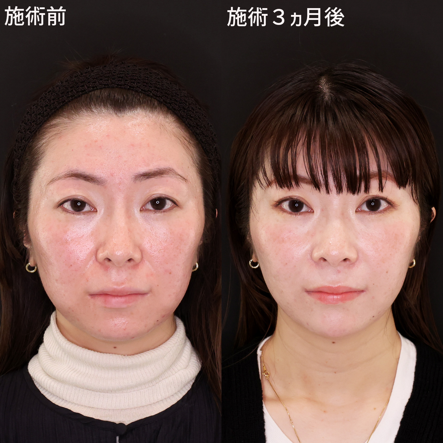 ナチュラルに輪郭を整える！【小顔複合術】