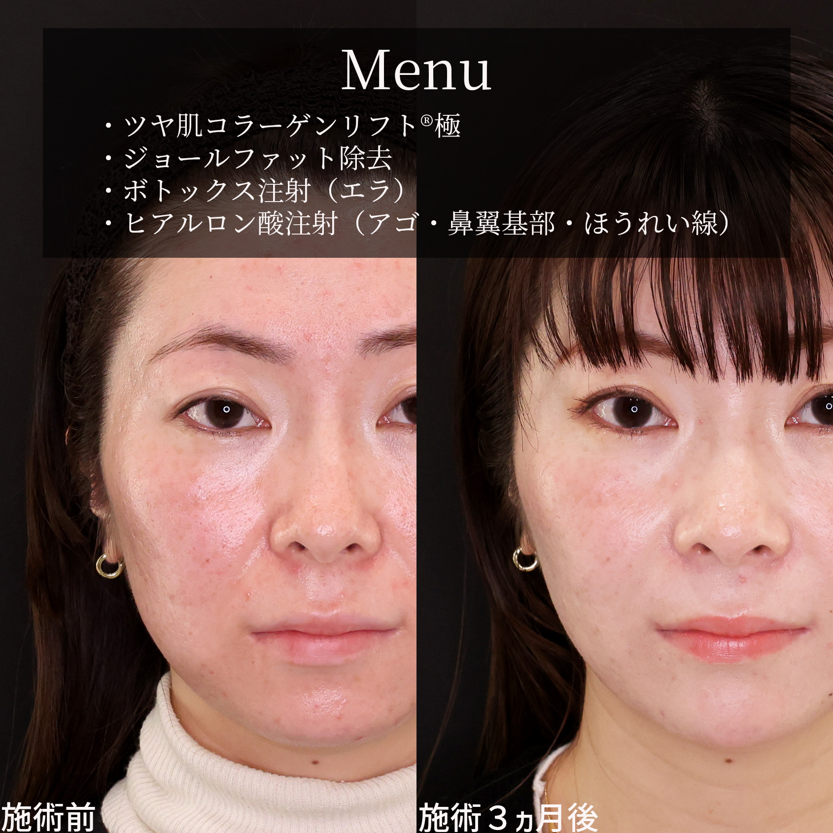 TAC式 ツヤ肌コラーゲンリフト®/ジョールファット除去/エラボトックス注射の症例写真 施術前後 