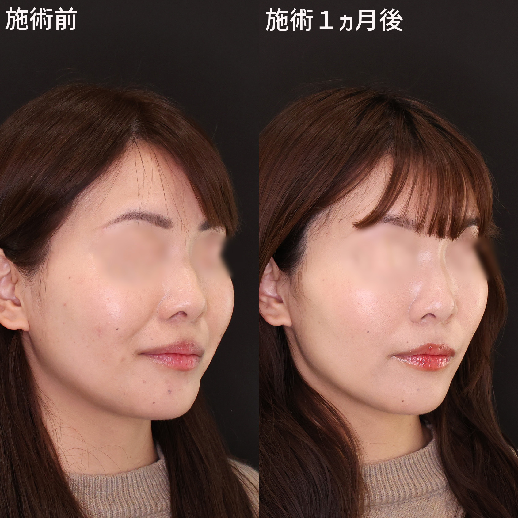 【糸リフト＋ヒアルロン酸】弛みとほうれい線を撃退する