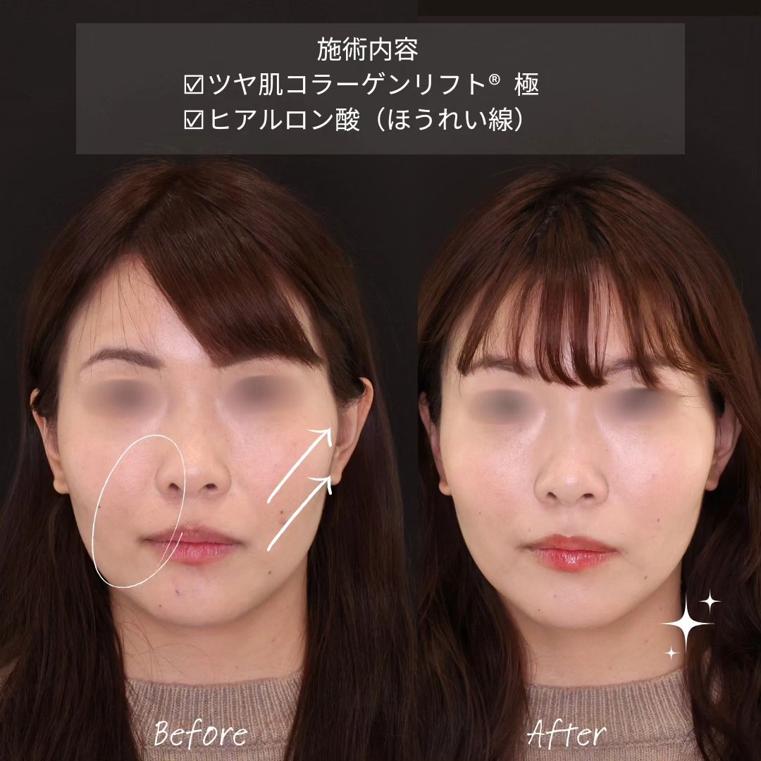 TAC式 ツヤ肌コラーゲンリフト®/ほうれい線のヒアルロン酸注射の症例写真 施術前後 