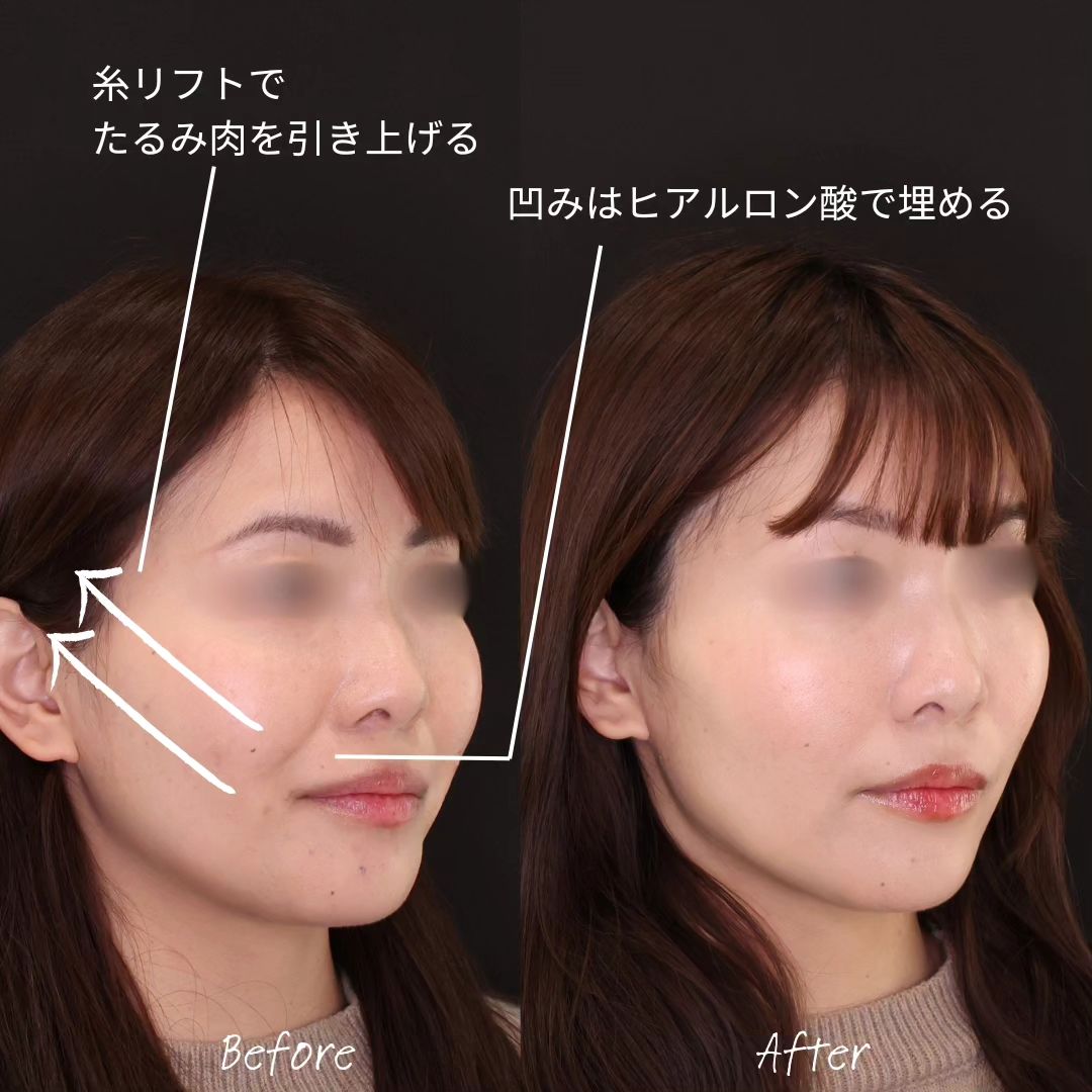 TAC式 ツヤ肌コラーゲンリフト®/ほうれい線のヒアルロン酸注射の症例写真 施術前後 