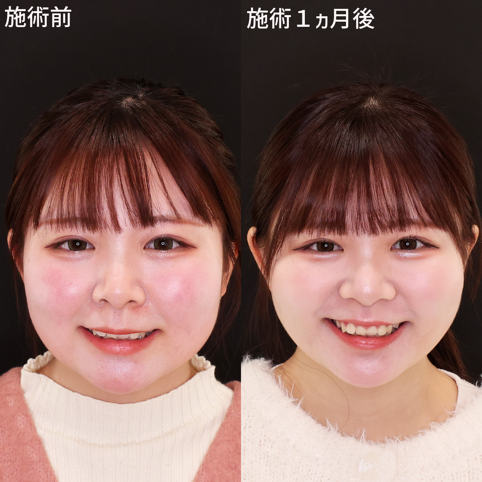 【小顔複合術】下膨れを改善して圧倒的に垢抜ける！