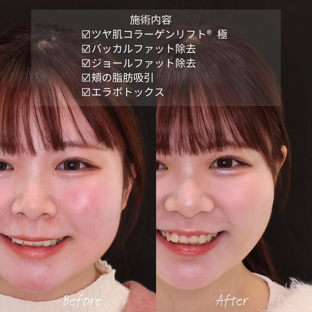 TAC式 ツヤ肌コラーゲンリフト®/バッカルファット除去/ジョールファット除去の症例写真 施術前後 