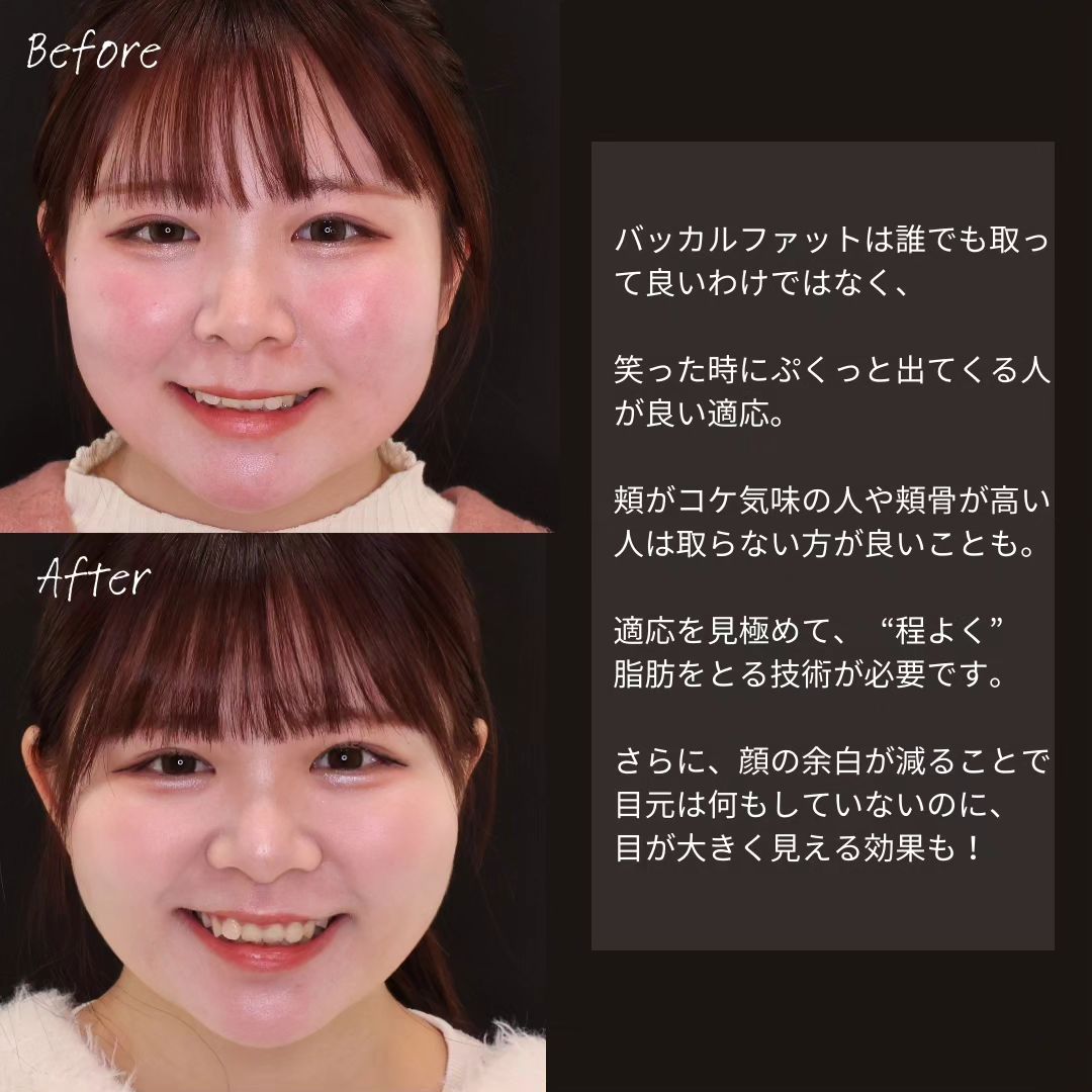 TAC式 ツヤ肌コラーゲンリフト®/バッカルファット除去/ジョールファット除去の症例写真 施術前後 