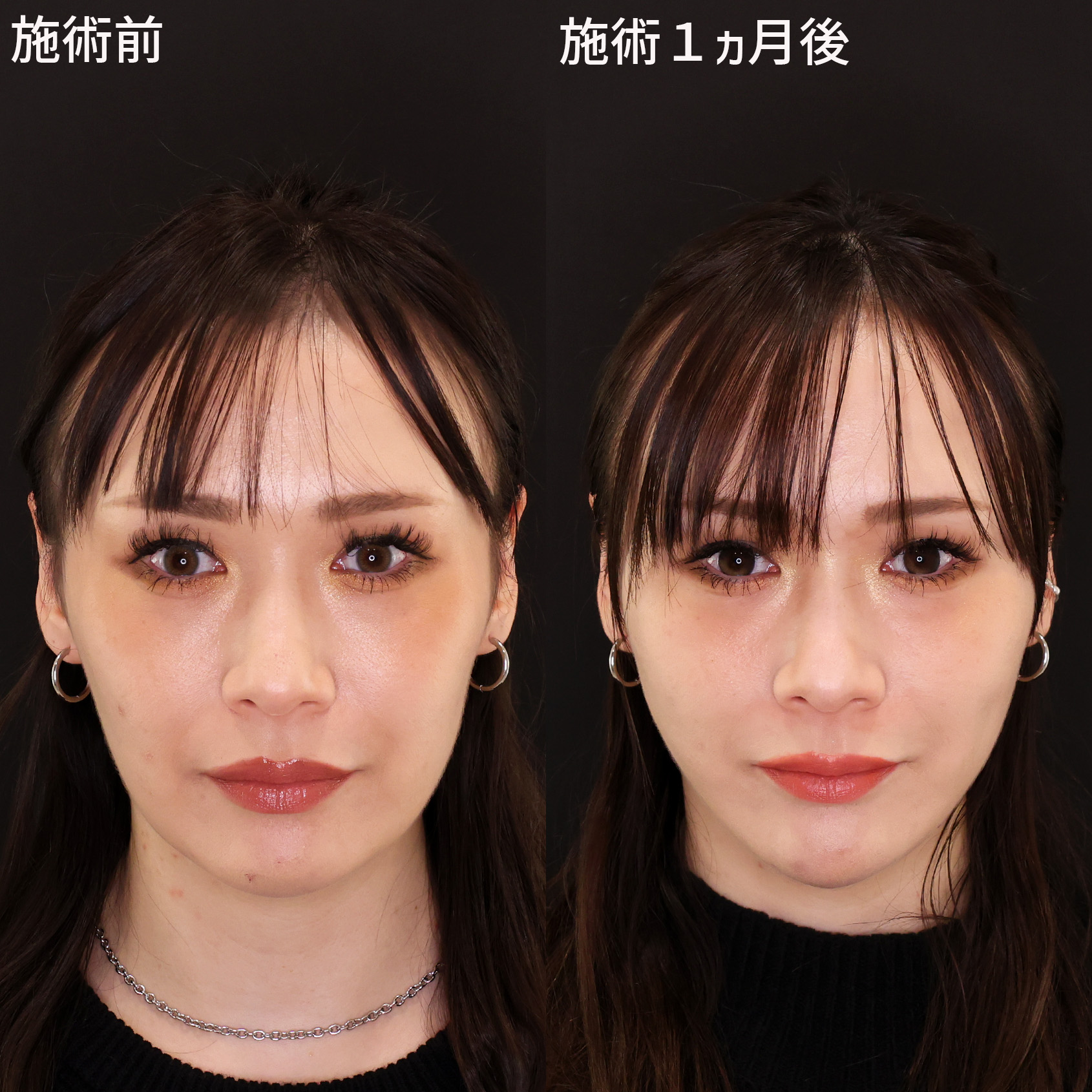 【糸リフト】四角型→卵型輪郭に導く小顔術