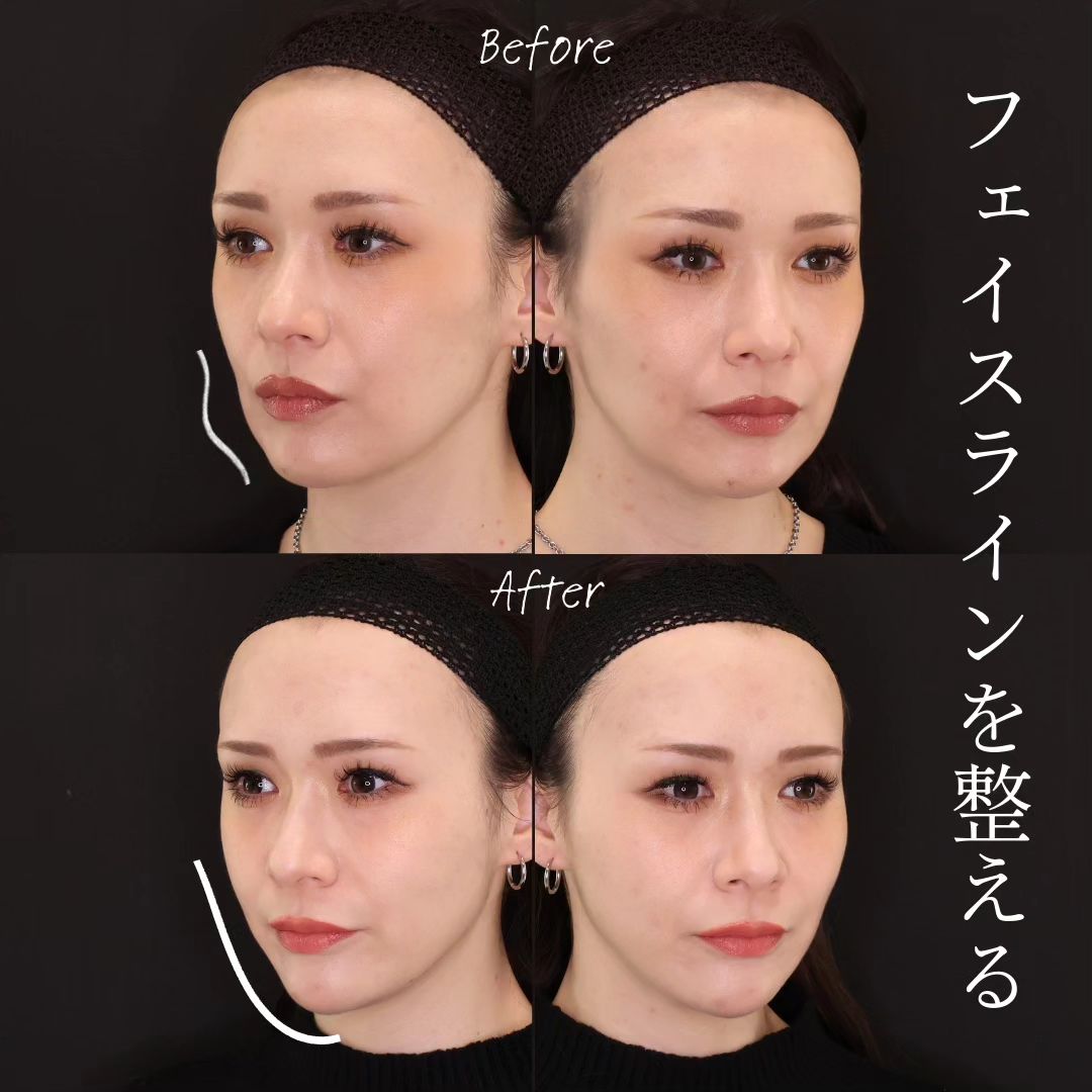 TAC式 ツヤ肌コラーゲンリフト®/TAC式 ショッピングリフト/顎のヒアルロン酸注射の症例写真 施術前後 