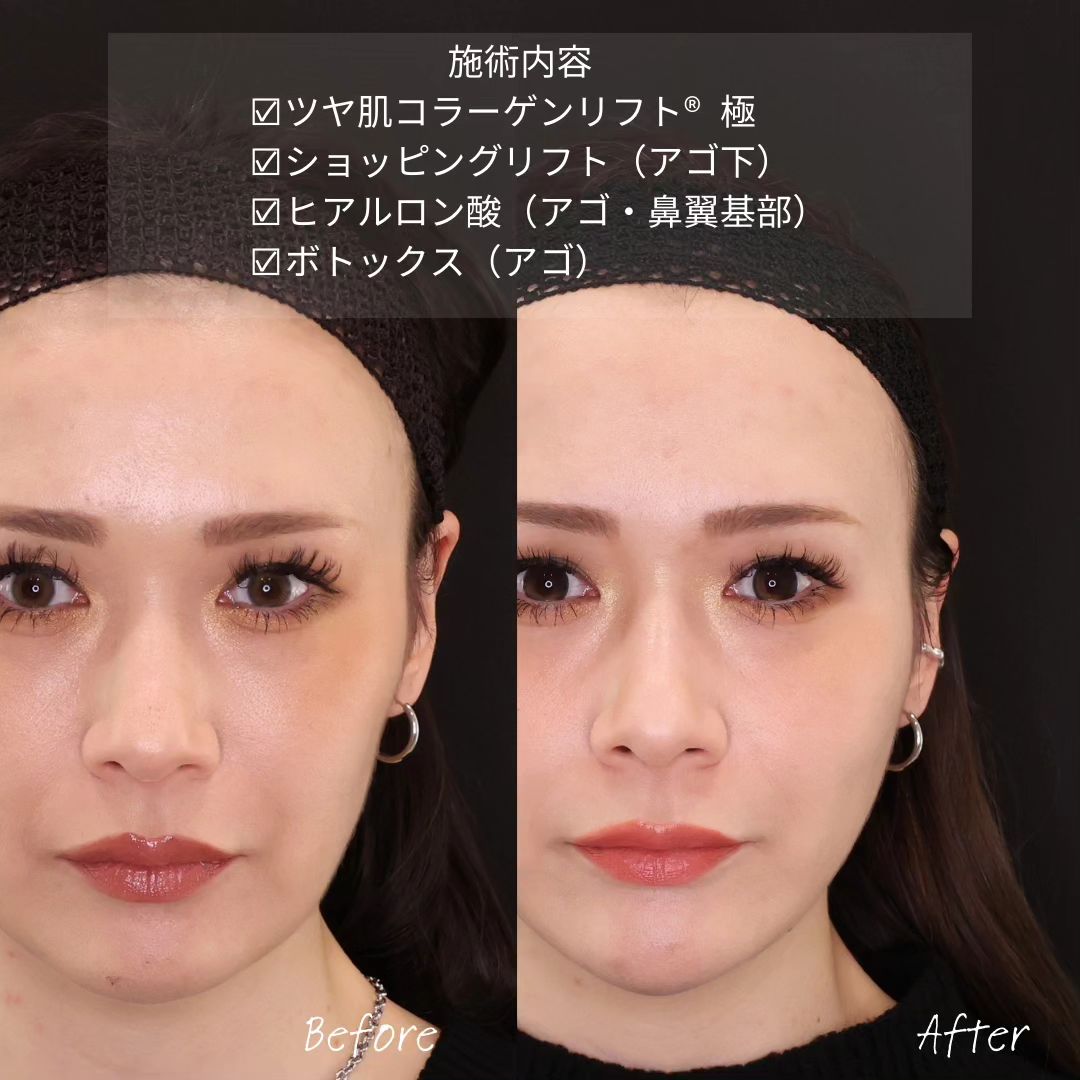 TAC式 ツヤ肌コラーゲンリフト®/TAC式 ショッピングリフト/顎のヒアルロン酸注射の症例写真 施術前後 