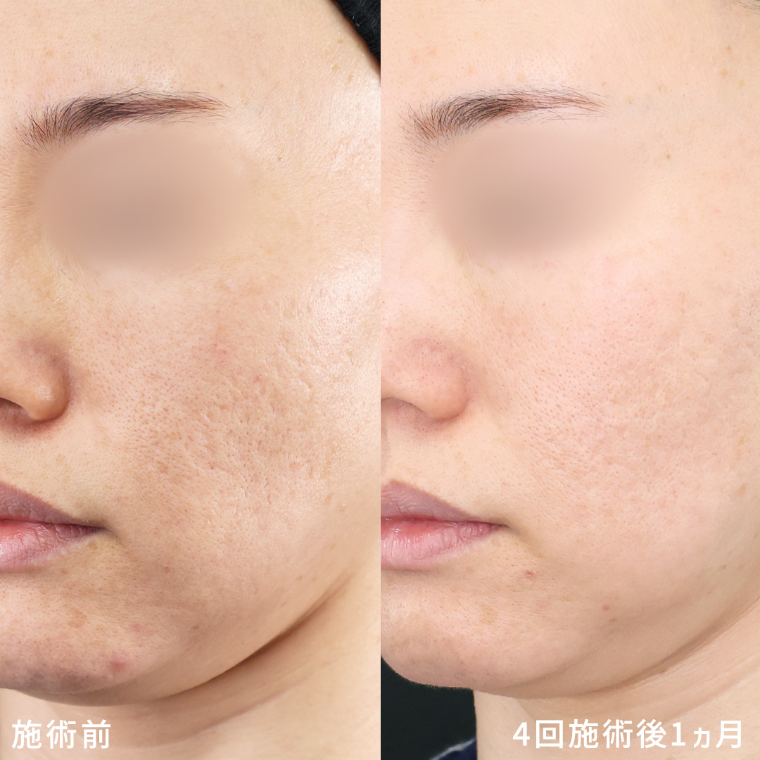 ダーマペン4 × エクソソーム美容液｜ニキビ跡・毛穴・クレーターの肌質改善