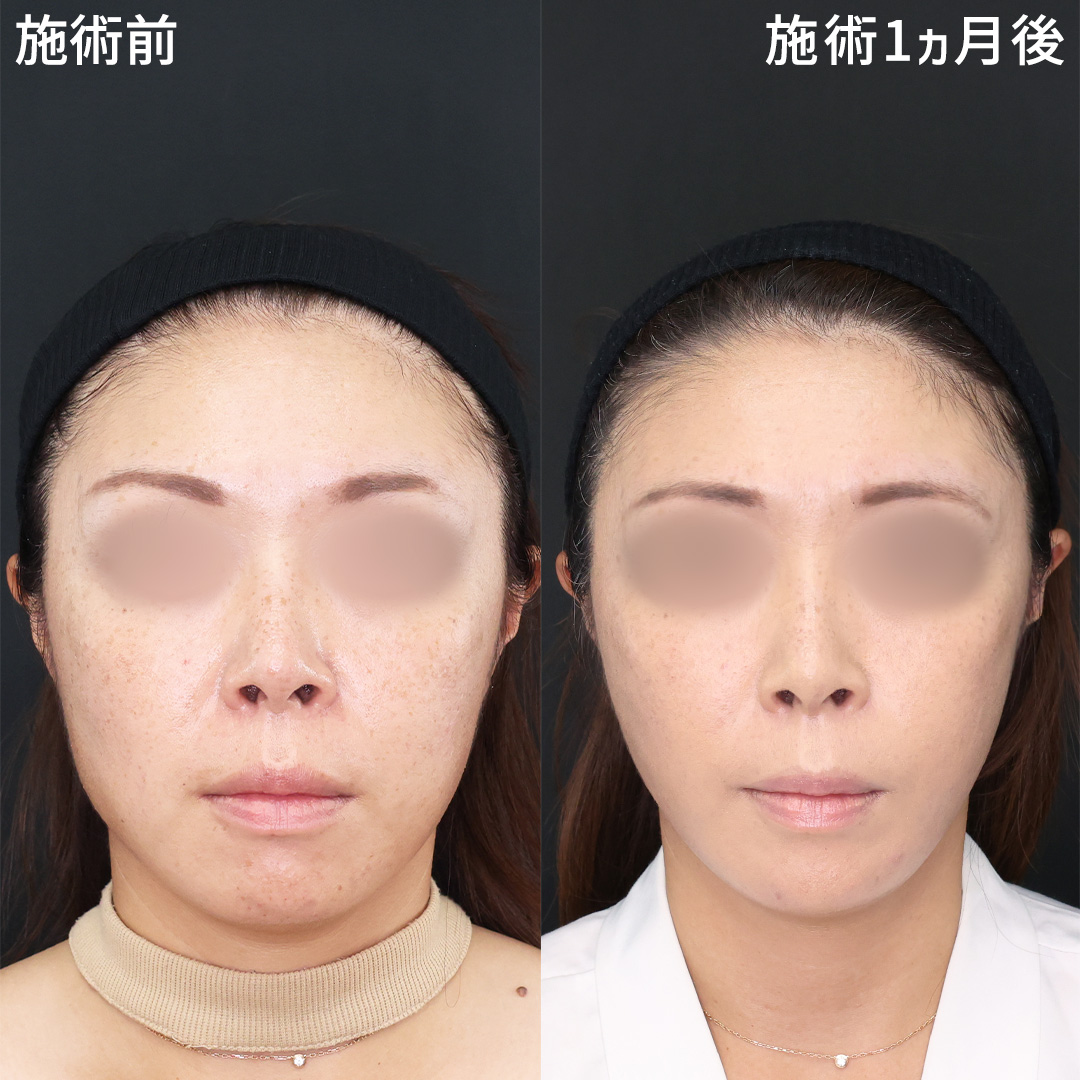 《たるみ》糸リフトだけでこの変化