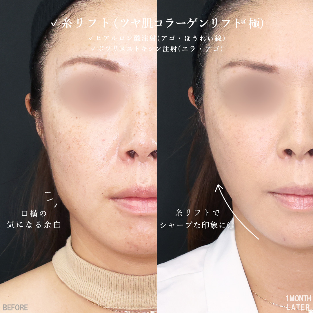 TAC式 ツヤ肌コラーゲンリフト®/顎のヒアルロン酸注射/ほうれい線のヒアルロン酸注射の症例写真 施術前後 