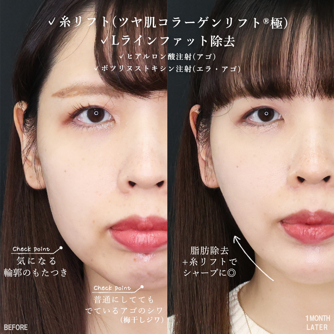 小顔整形｜パーフェクトフェイスライン/TAC式 ツヤ肌コラーゲンリフト®/Lラインファット除去（エラ下脂肪除去）の症例写真 施術前後 