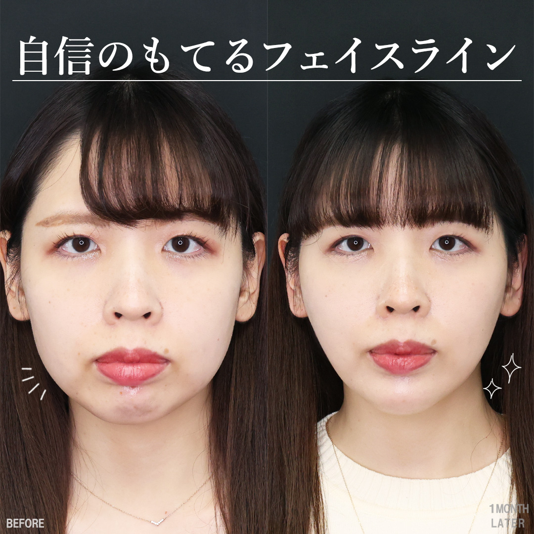 小顔整形｜パーフェクトフェイスライン/TAC式 ツヤ肌コラーゲンリフト®/Lラインファット除去（エラ下脂肪除去）の症例写真 施術前後 