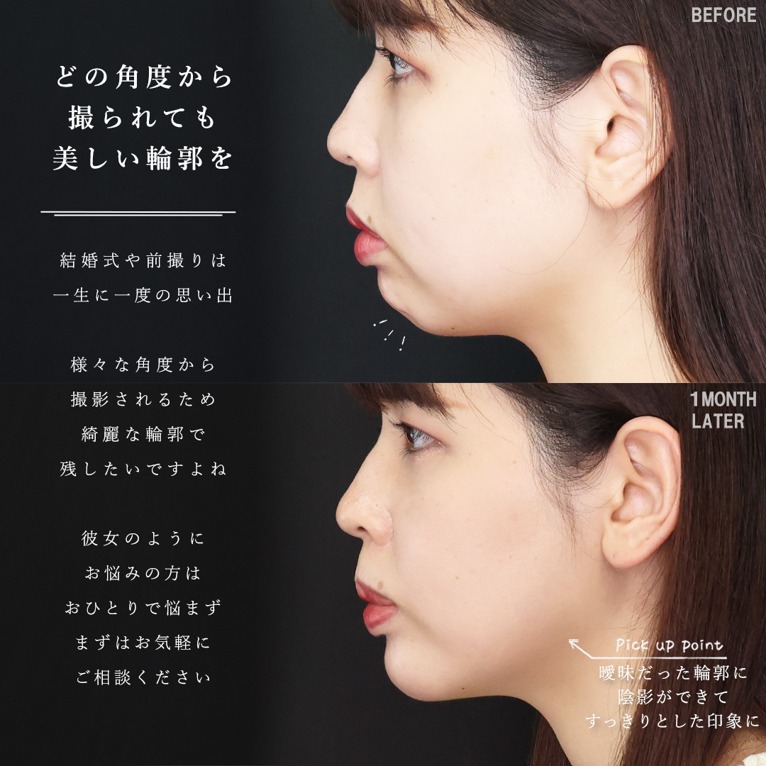 小顔整形｜パーフェクトフェイスライン/TAC式 ツヤ肌コラーゲンリフト®/Lラインファット除去（エラ下脂肪除去）の症例写真 施術前後 