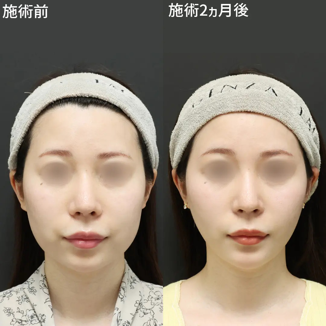 《パーフェクトフェイスライン》でアイドル級小顔に