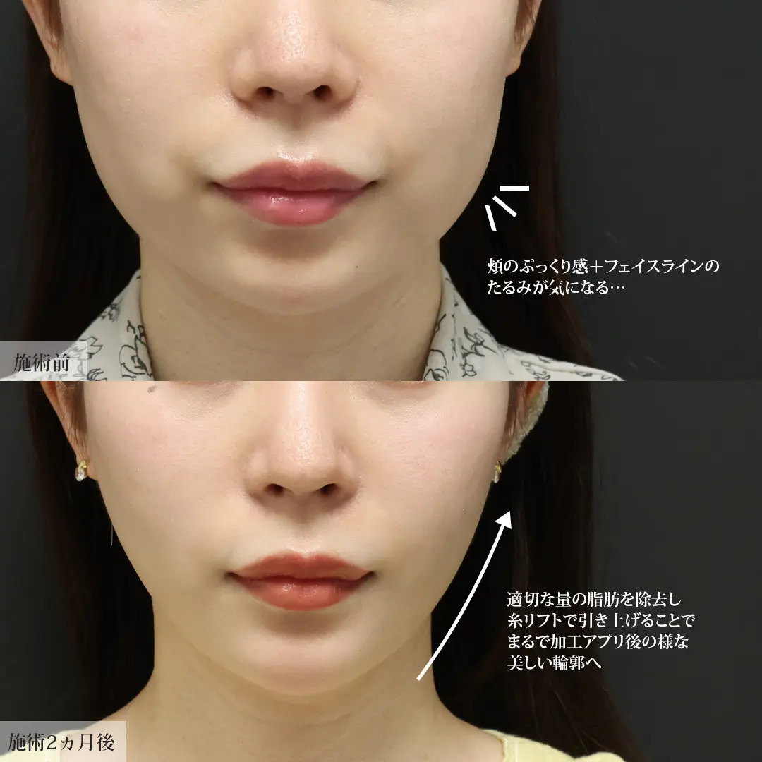 TAC式 ツヤ肌コラーゲンリフト®/ジョールファット除去/Lラインファット除去（エラ下脂肪除去）の症例写真 施術前後 