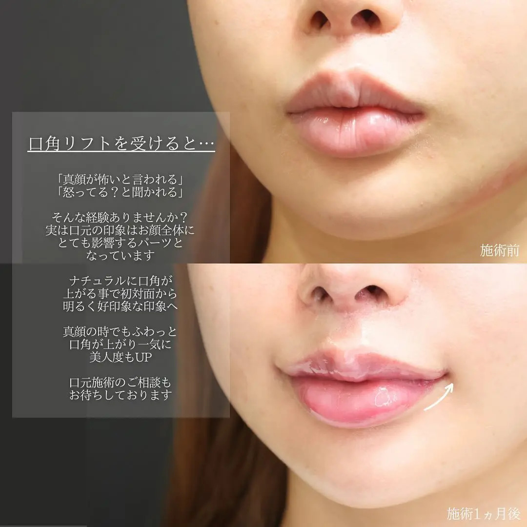 口角挙上・リフト（マイクロ切開法・内側法/口内法）の症例写真 施術前後 