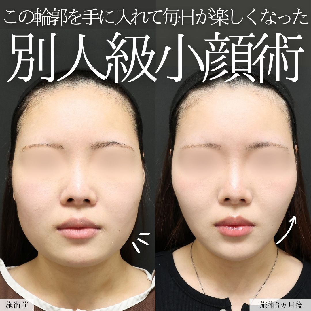 TAC式 ツヤ肌コラーゲンリフト®/バッカルファット除去/ジョールファット除去の症例写真 施術前後 