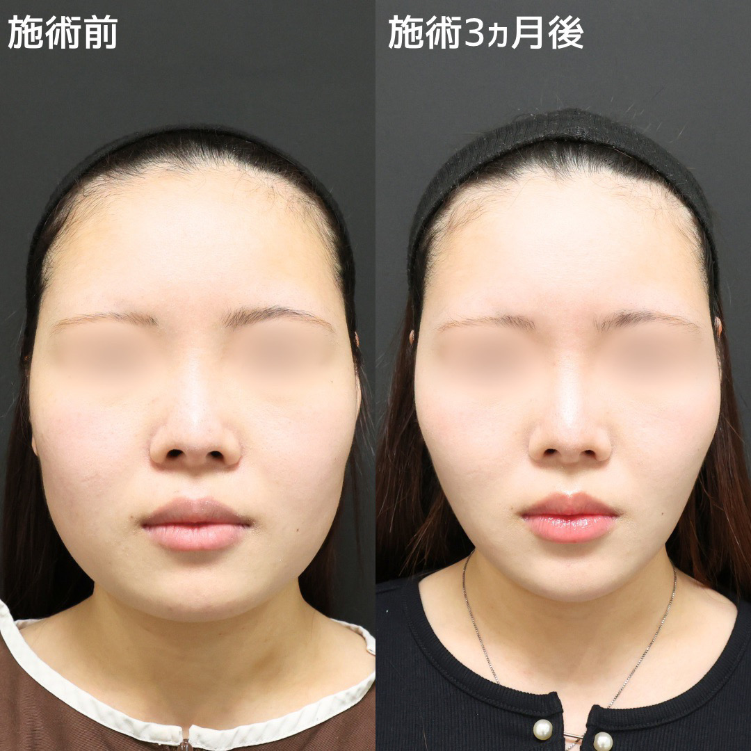 《小顔整形》ゴツゴツとした輪郭からの卒業