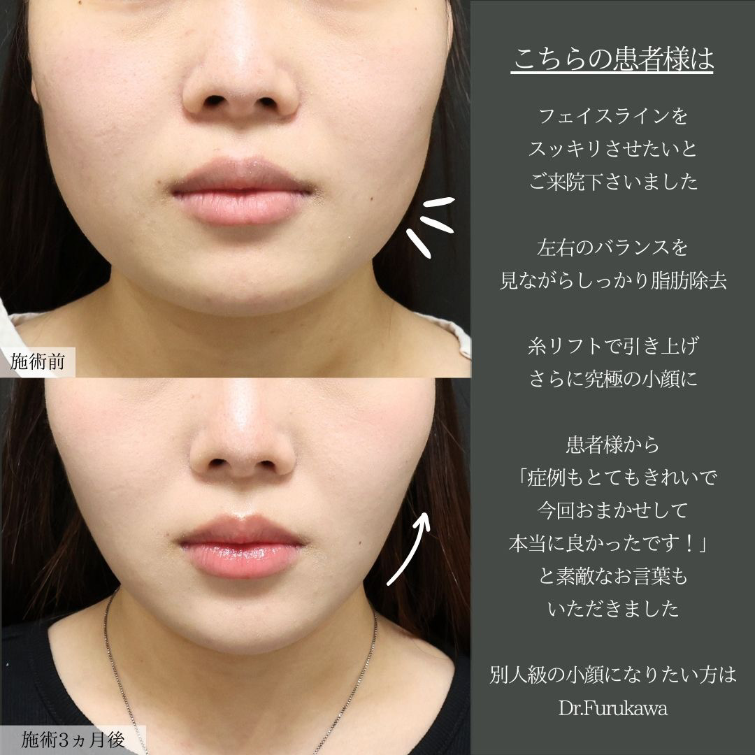 TAC式 ツヤ肌コラーゲンリフト®/バッカルファット除去/ジョールファット除去の症例写真 施術前後 