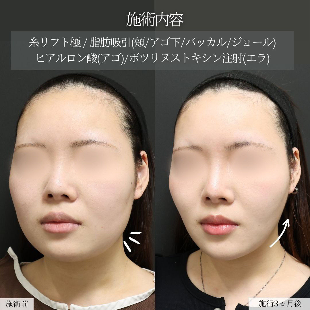TAC式 ツヤ肌コラーゲンリフト®/バッカルファット除去/ジョールファット除去の症例写真 施術前後 