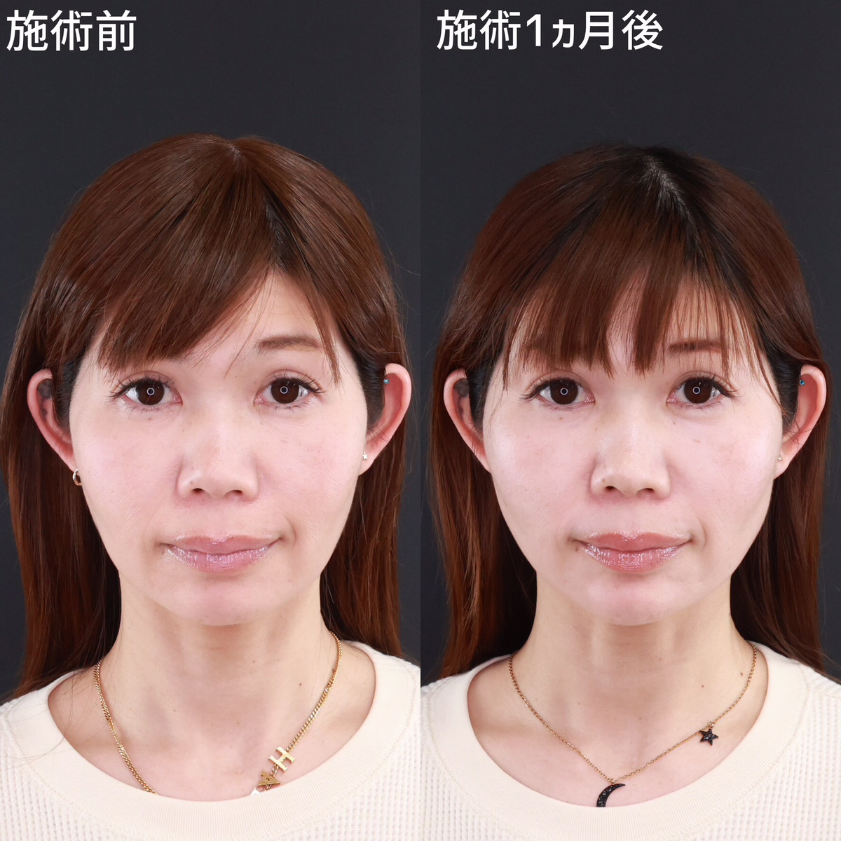 【小顔整形】フェイスラインを整え若々しい印象へ