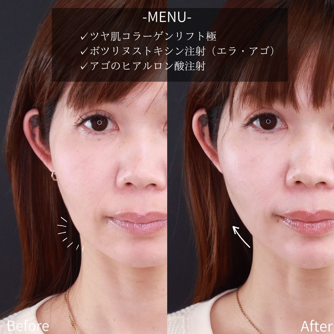 TAC式 ツヤ肌コラーゲンリフト®/エラボトックス注射/ボトックス注射:その他の症例写真 施術前後