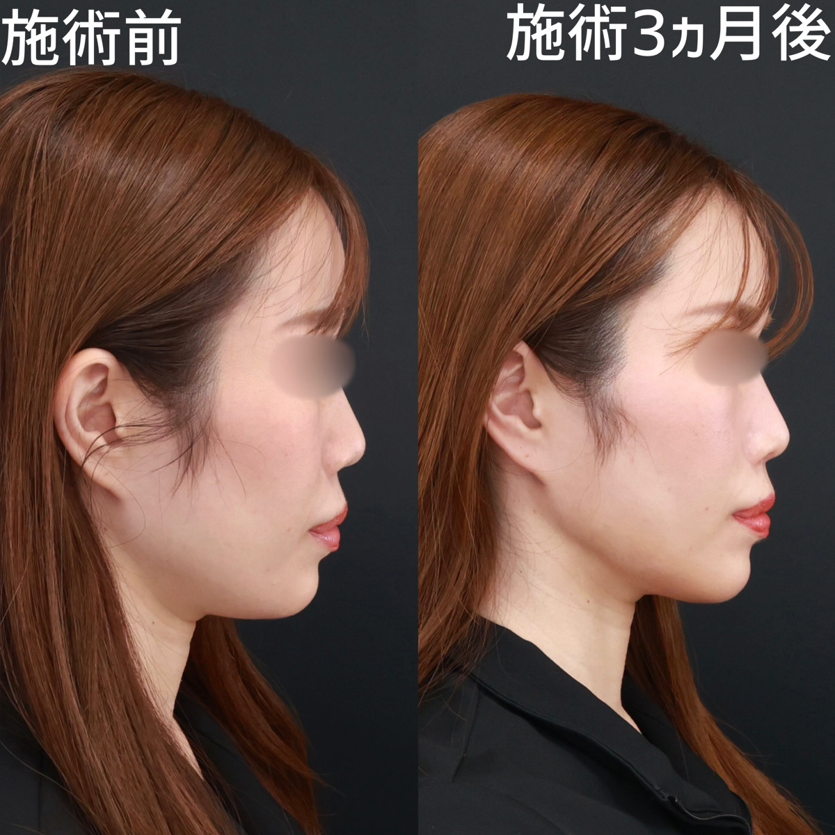 【顎下脂肪吸引×糸リフト極】二重顎を解消し洗練された横顔に！