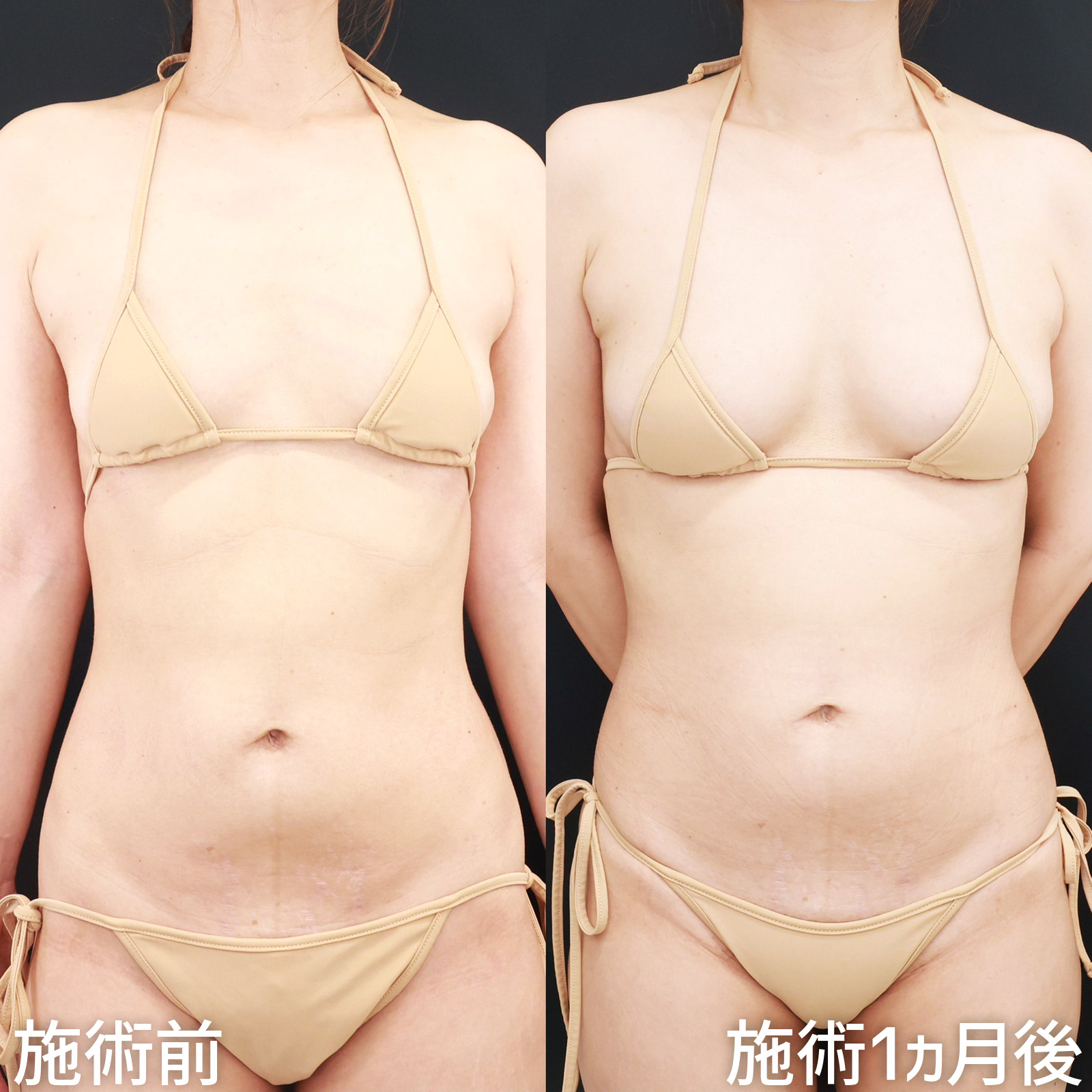 脂肪注入豊胸（コンデンスリッチ・ピュアグラフト・１day脂肪豊胸）の症例写真 施術前後 