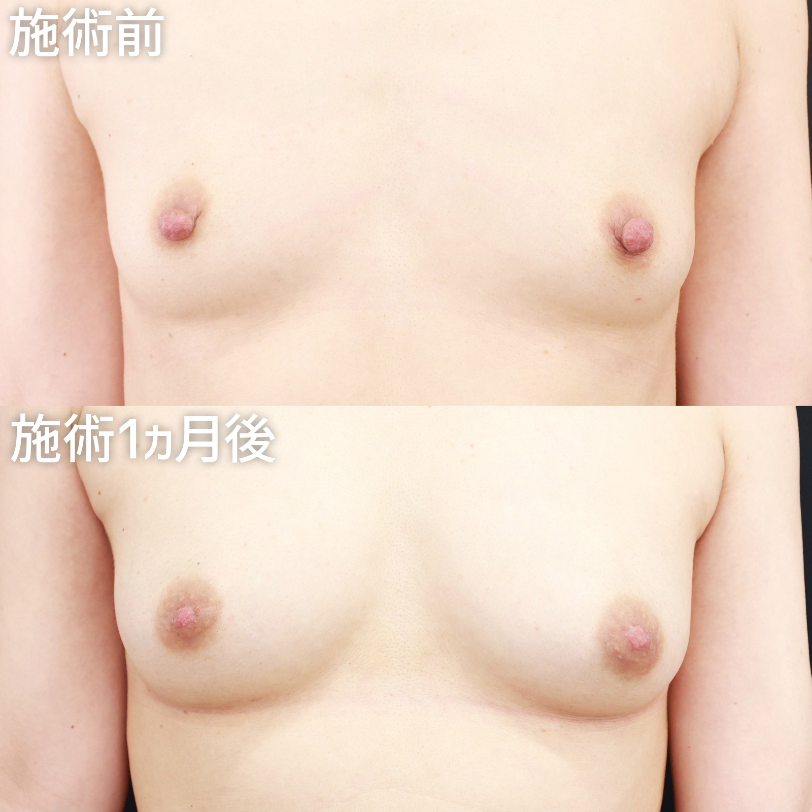 【乳頭縮小術】授乳で伸びてしまった乳頭の形を美しく整える