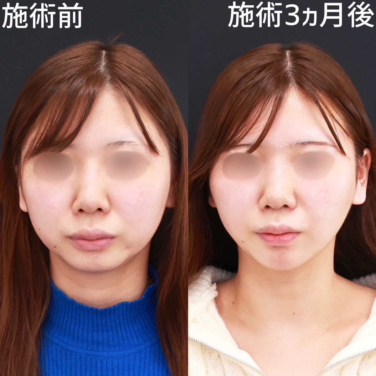 【脂肪吸引×糸リフト極】お顔のボリュームダウンで丸顔を解消！