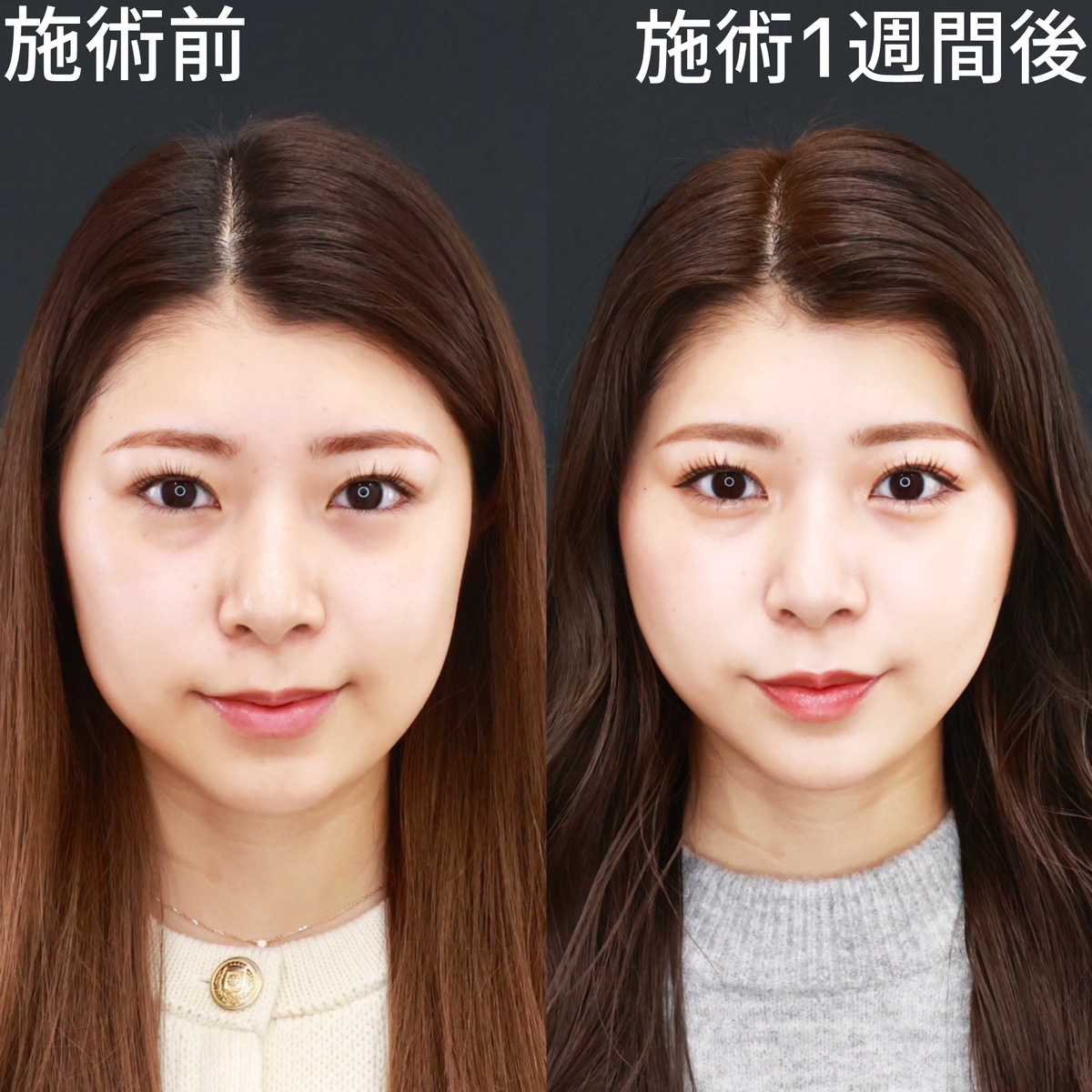 【糸リフト極】お顔の重心アップで垢抜ける！