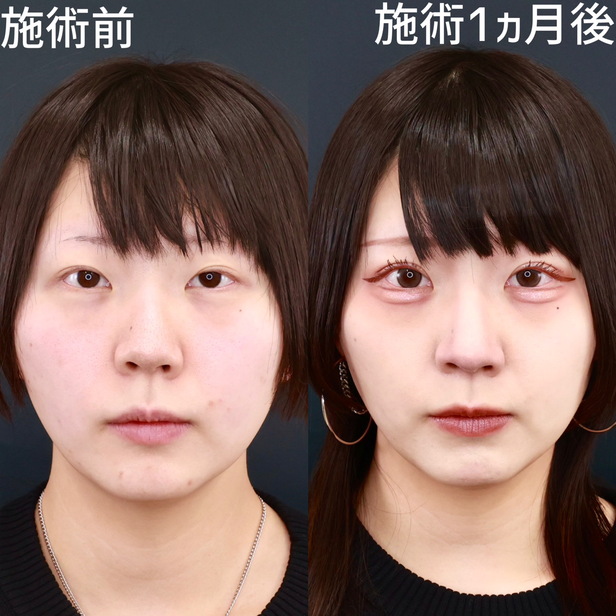 【二重埋没法】二重幅を広げてメイクが映える目元に！