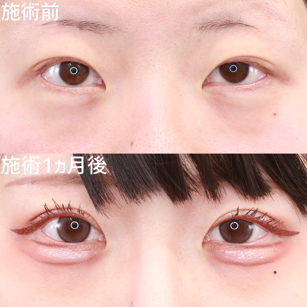 二重埋没法の症例写真 施術前後 