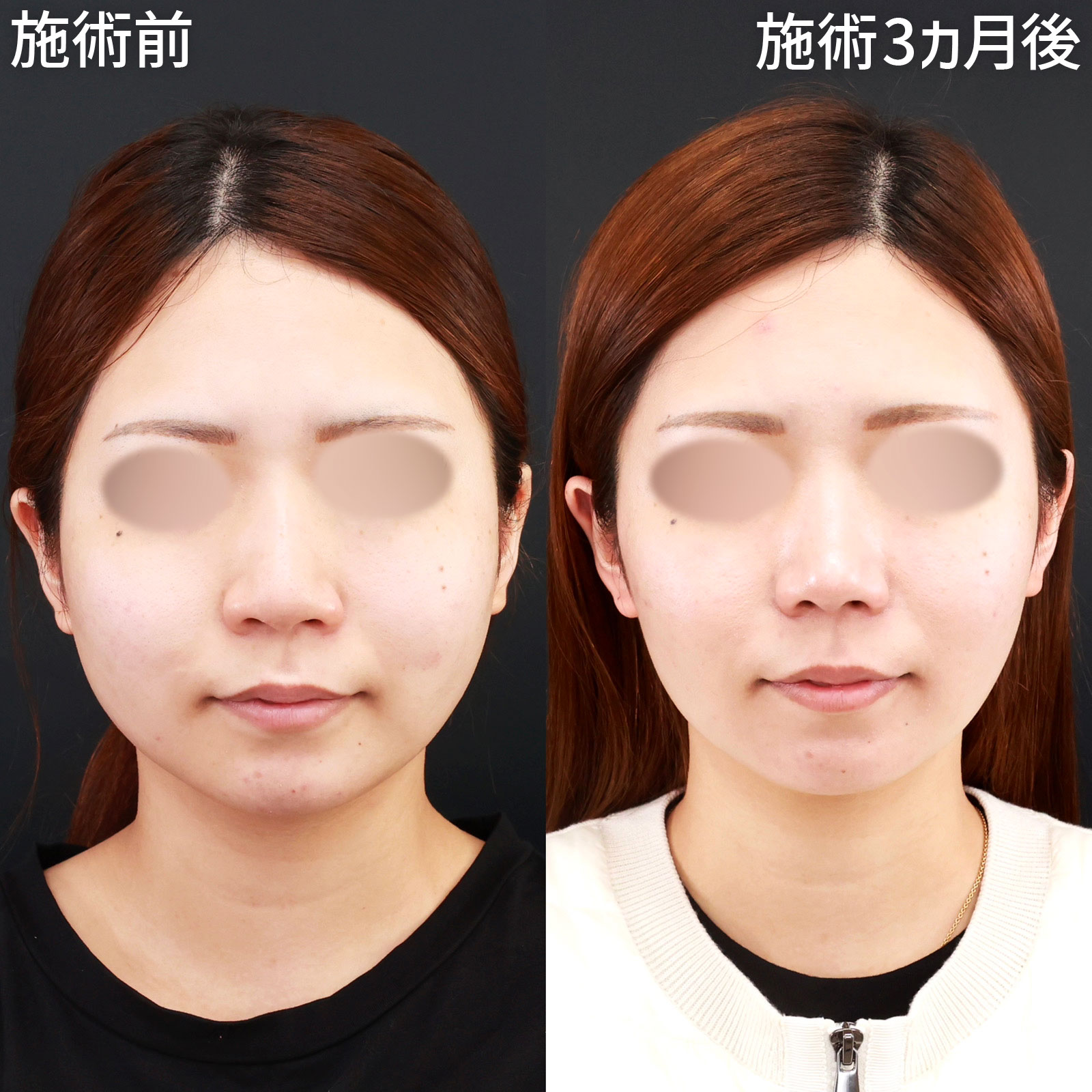 鼻中隔延長術/鼻先軟骨移植/鼻尖形成・鼻尖縮小の症例写真 施術前後 