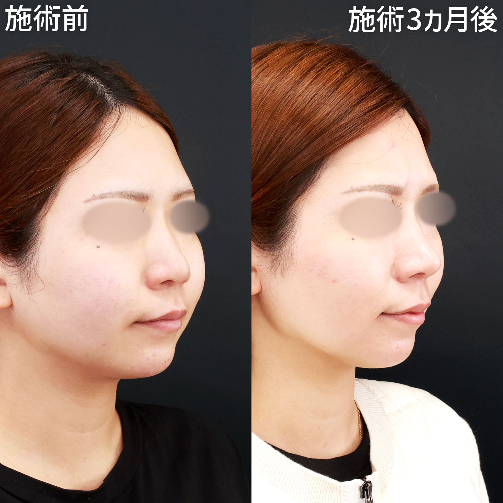 鼻中隔延長術/鼻先軟骨移植/鼻尖形成・鼻尖縮小の症例写真 施術前後 