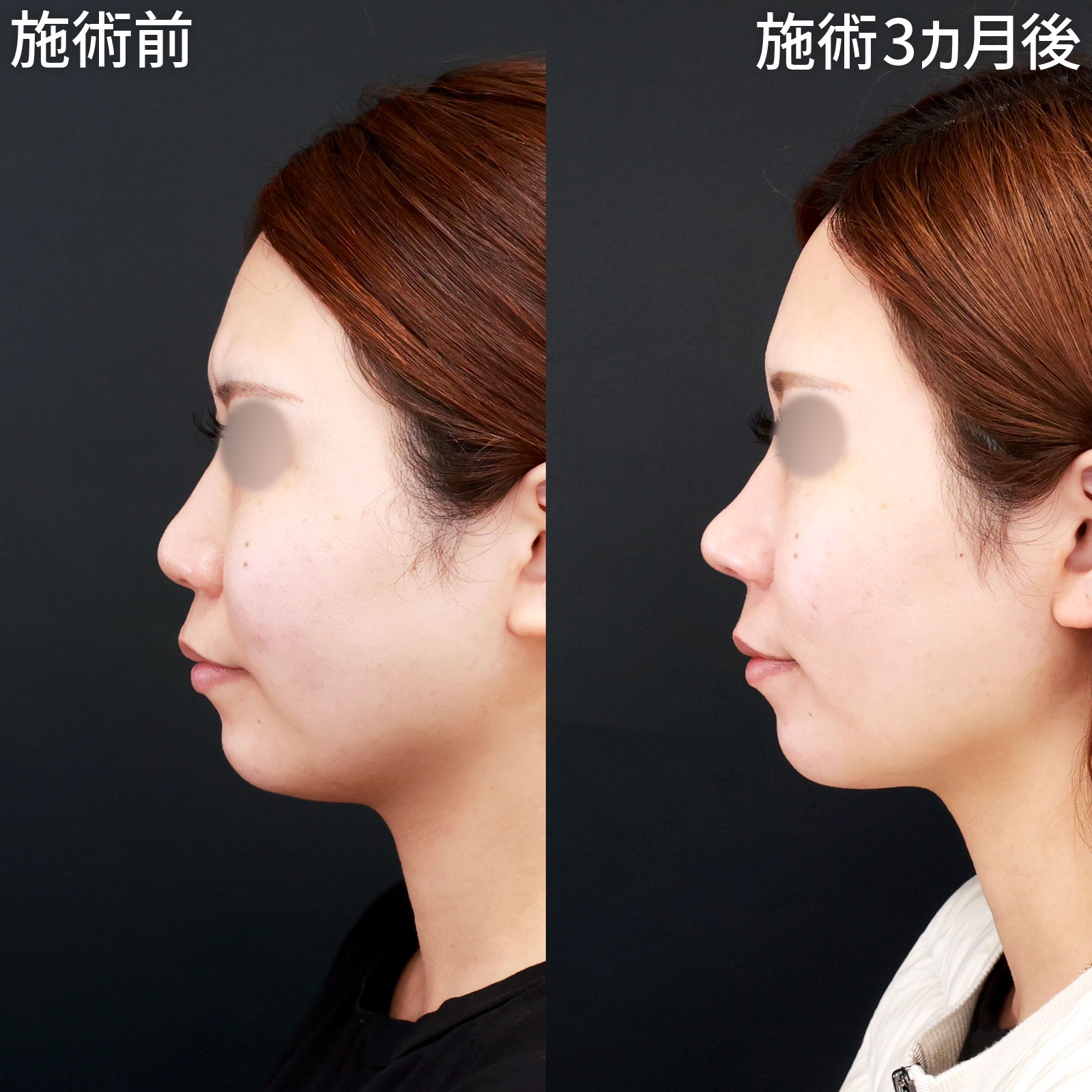 目と鼻の先 鼻整形 目頭切開 若返り『自然さ』にこだわる Dr.杉崎裕斗