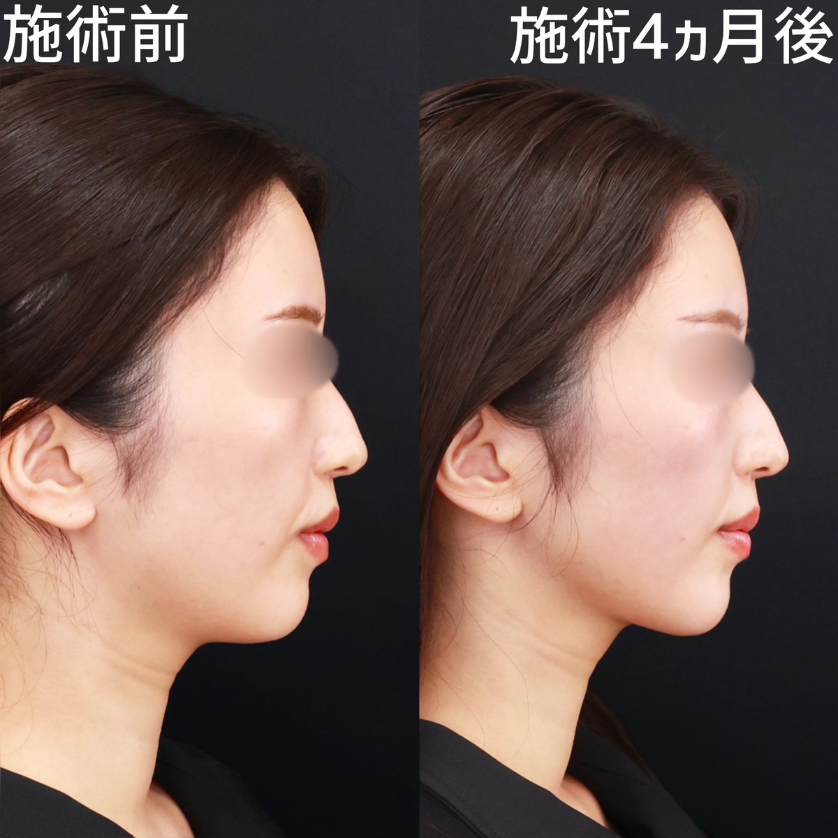 【顎下脂肪吸引×糸リフト極】クッキリとしたフェイスラインで横顔美人！