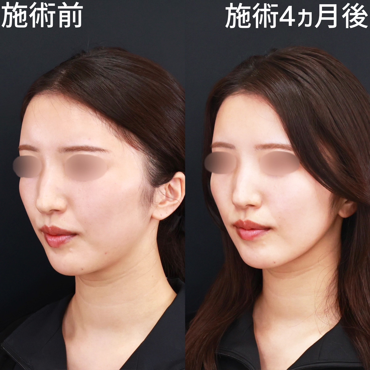 TAC式 ツヤ肌コラーゲンリフト®/顎下の脂肪吸引/Lラインファット除去（エラ下脂肪除去）の症例写真 施術前後 