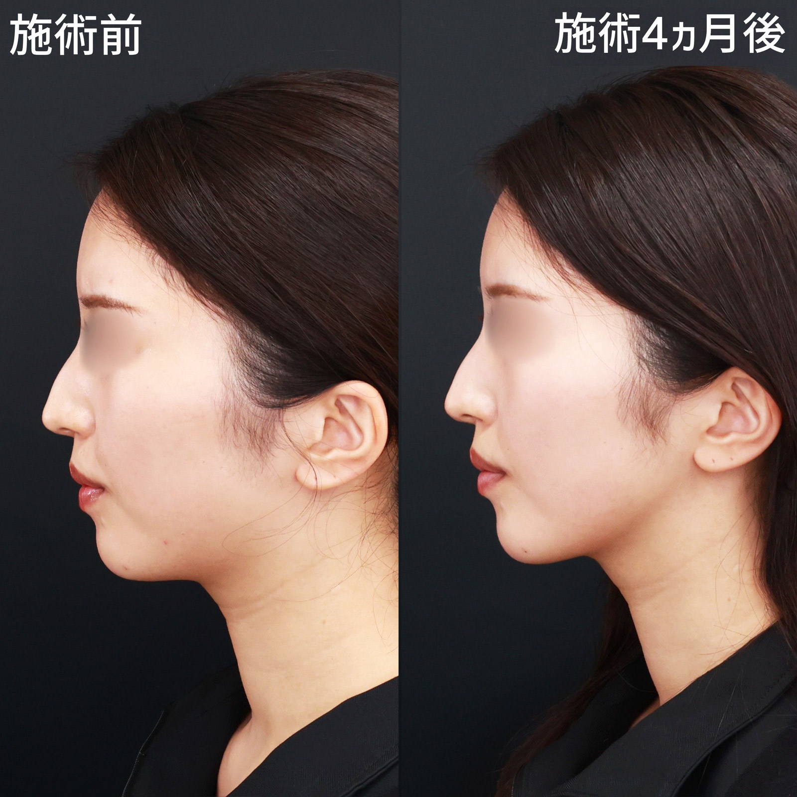 TAC式 ツヤ肌コラーゲンリフト®/顎下の脂肪吸引/Lラインファット除去（エラ下脂肪除去）の症例写真 施術前後 