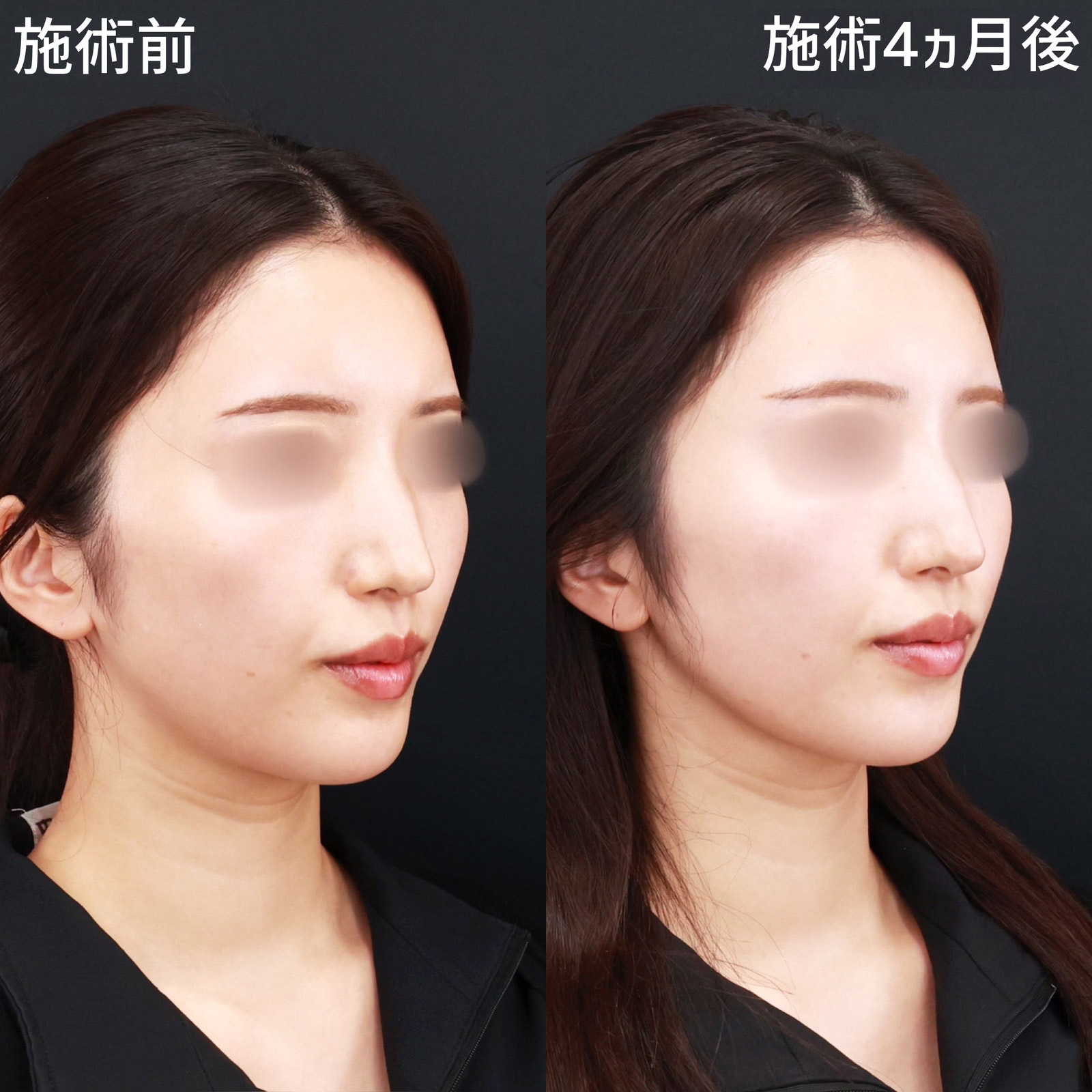 TAC式 ツヤ肌コラーゲンリフト®/顎下の脂肪吸引/Lラインファット除去（エラ下脂肪除去）の症例写真 施術前後 
