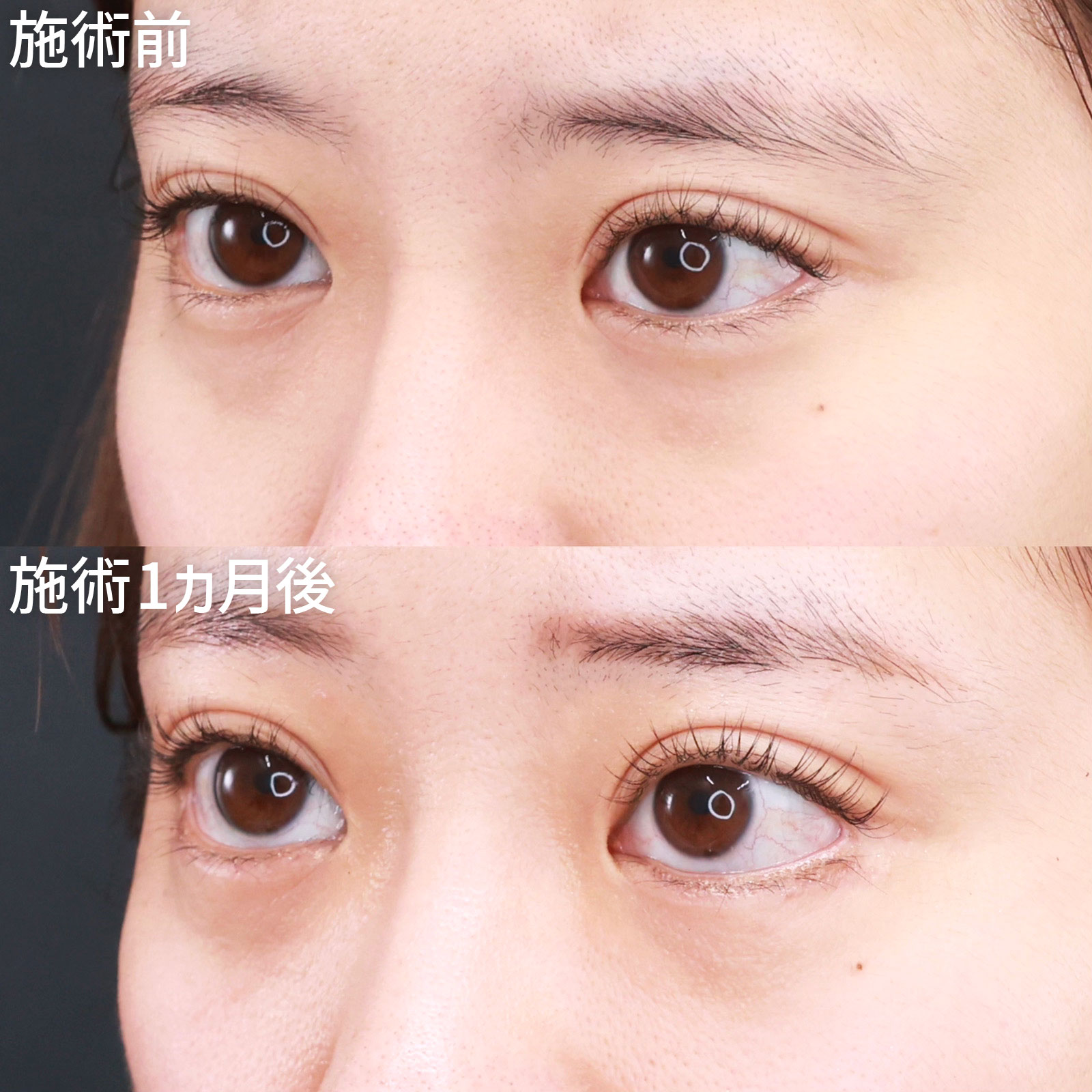 グラマラスライン（タレ目形成）の症例写真 施術前後 