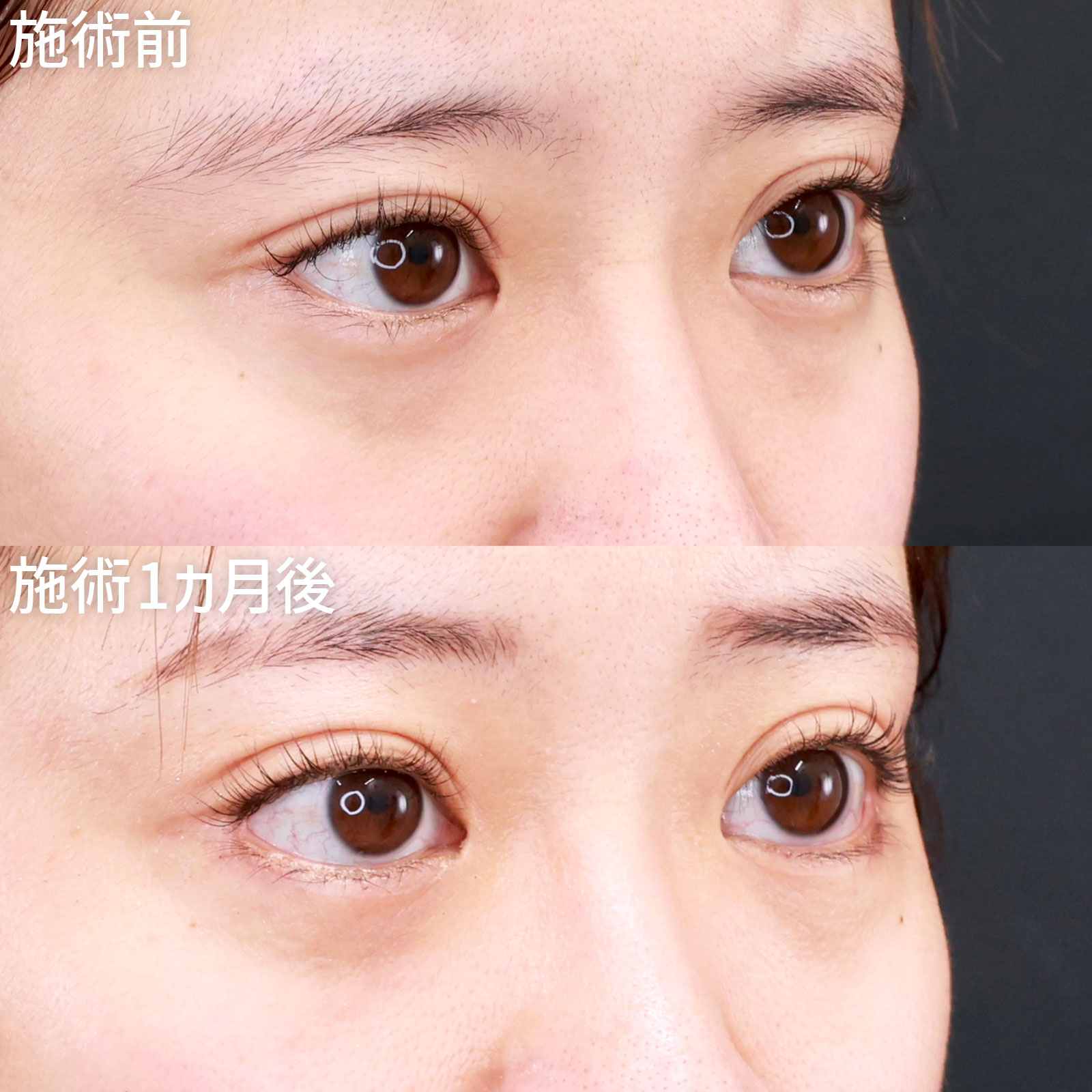 グラマラスライン（タレ目形成）の症例写真 施術前後 