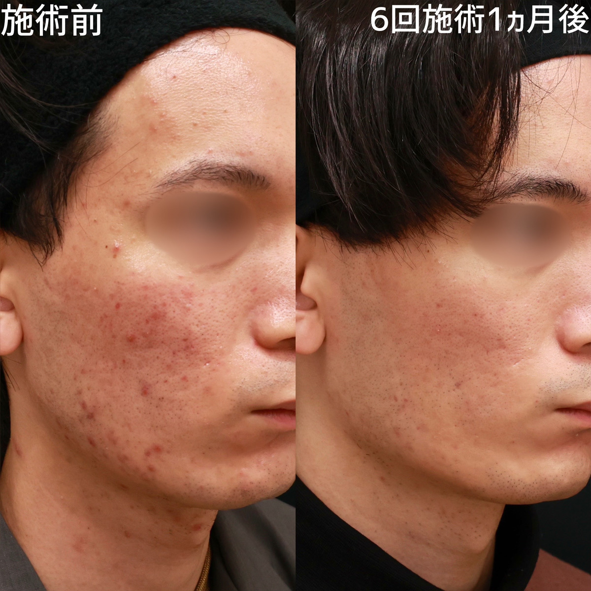 【ダーマペン×エクソソーム】ニキビができにくい肌質に改善！