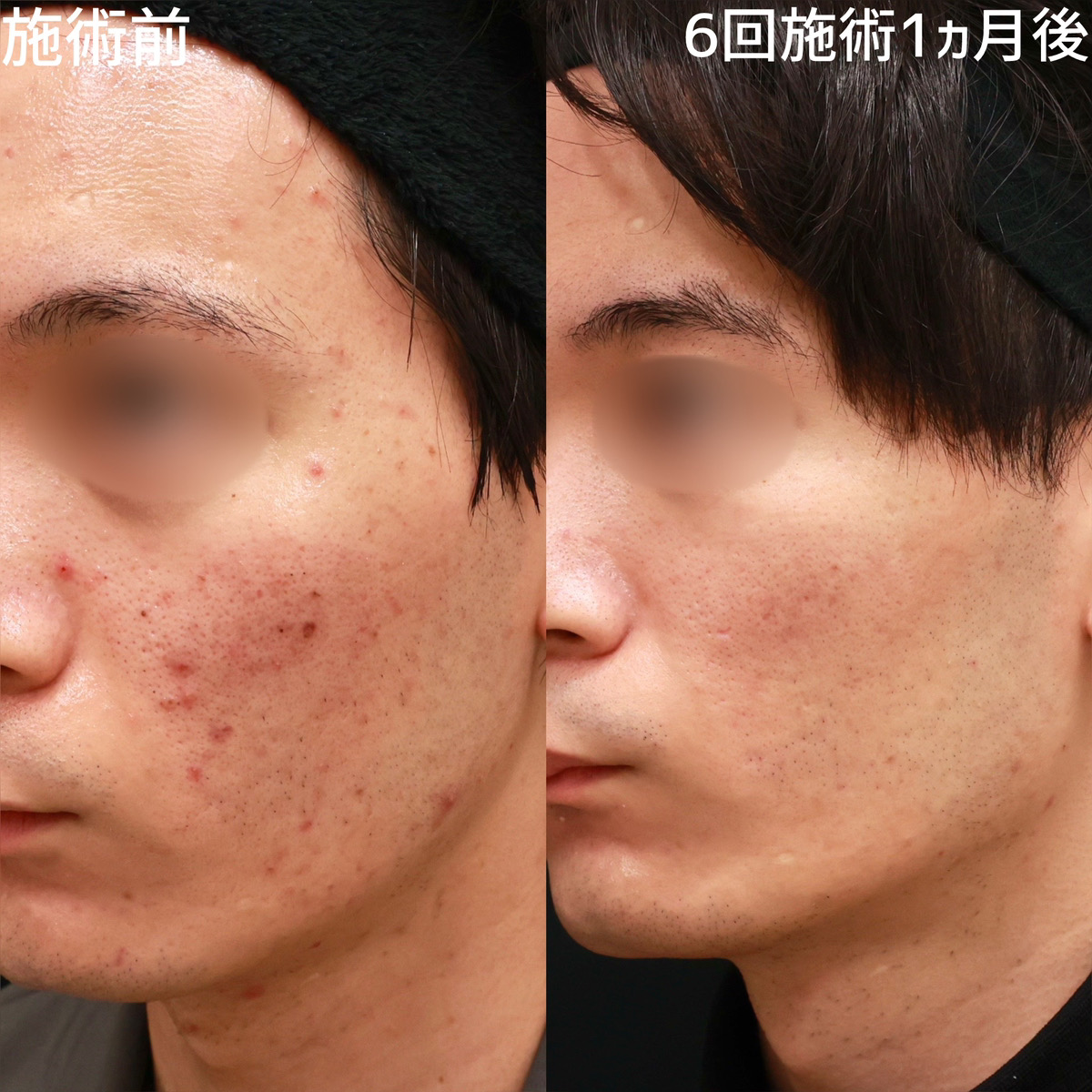 ダーマペン4/エクソソーム/ベルベットスキンの症例写真 施術前後 