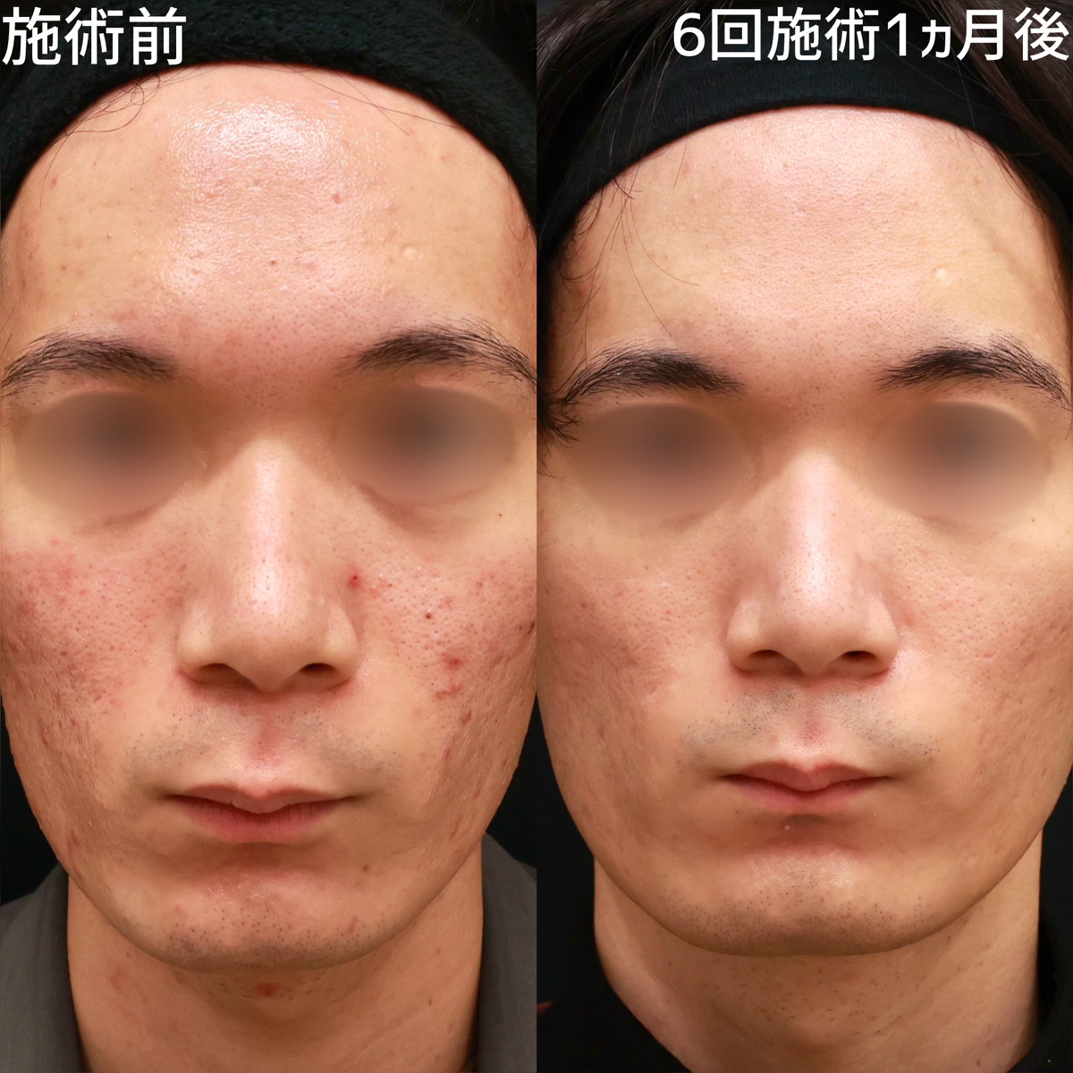 ダーマペン4/エクソソーム/ベルベットスキンの症例写真 施術前後 