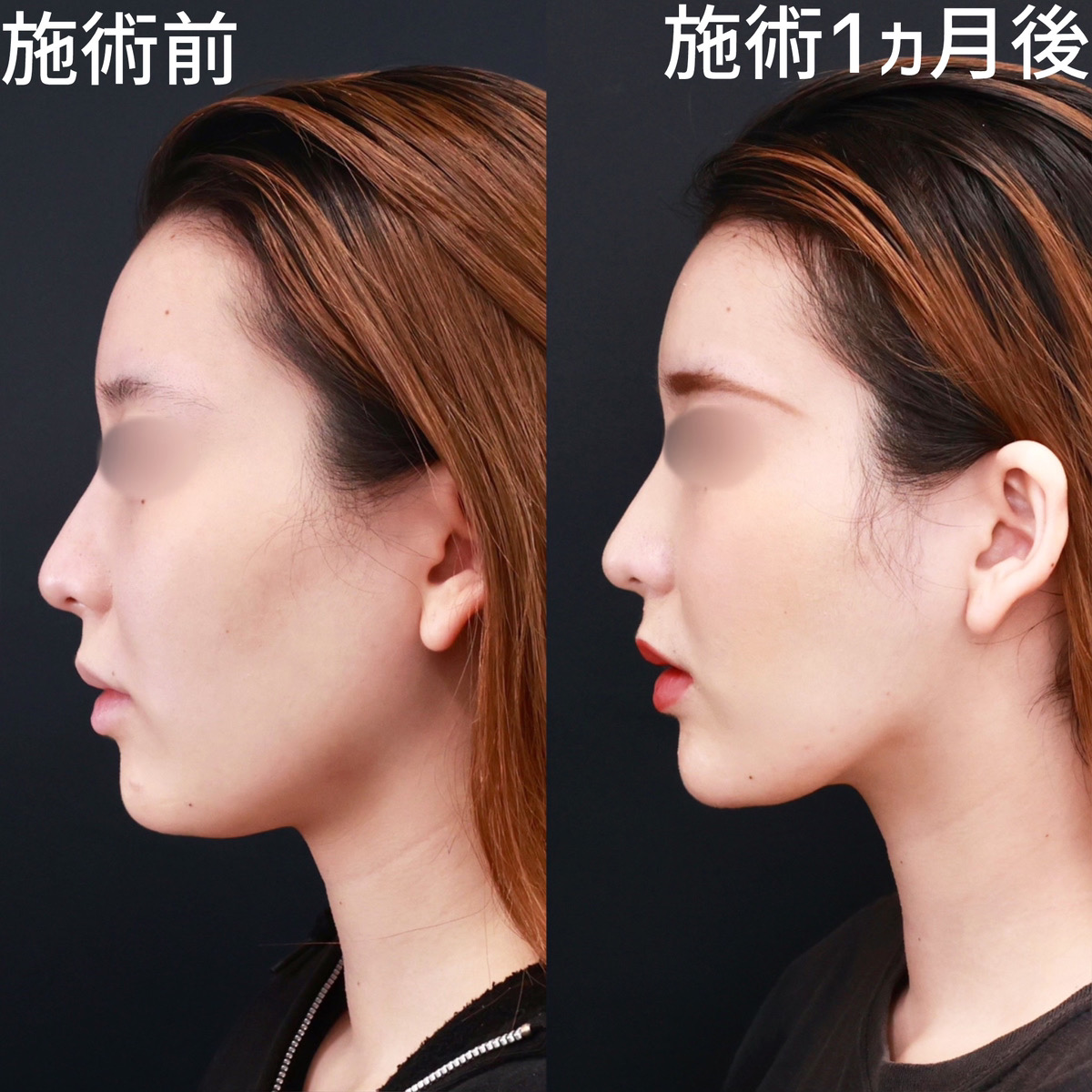 小顔整形|パーフェクトフェイスライン/TAC式 ツヤ肌コラーゲンリフト®/顔の脂肪吸引の症例写真 施術前後