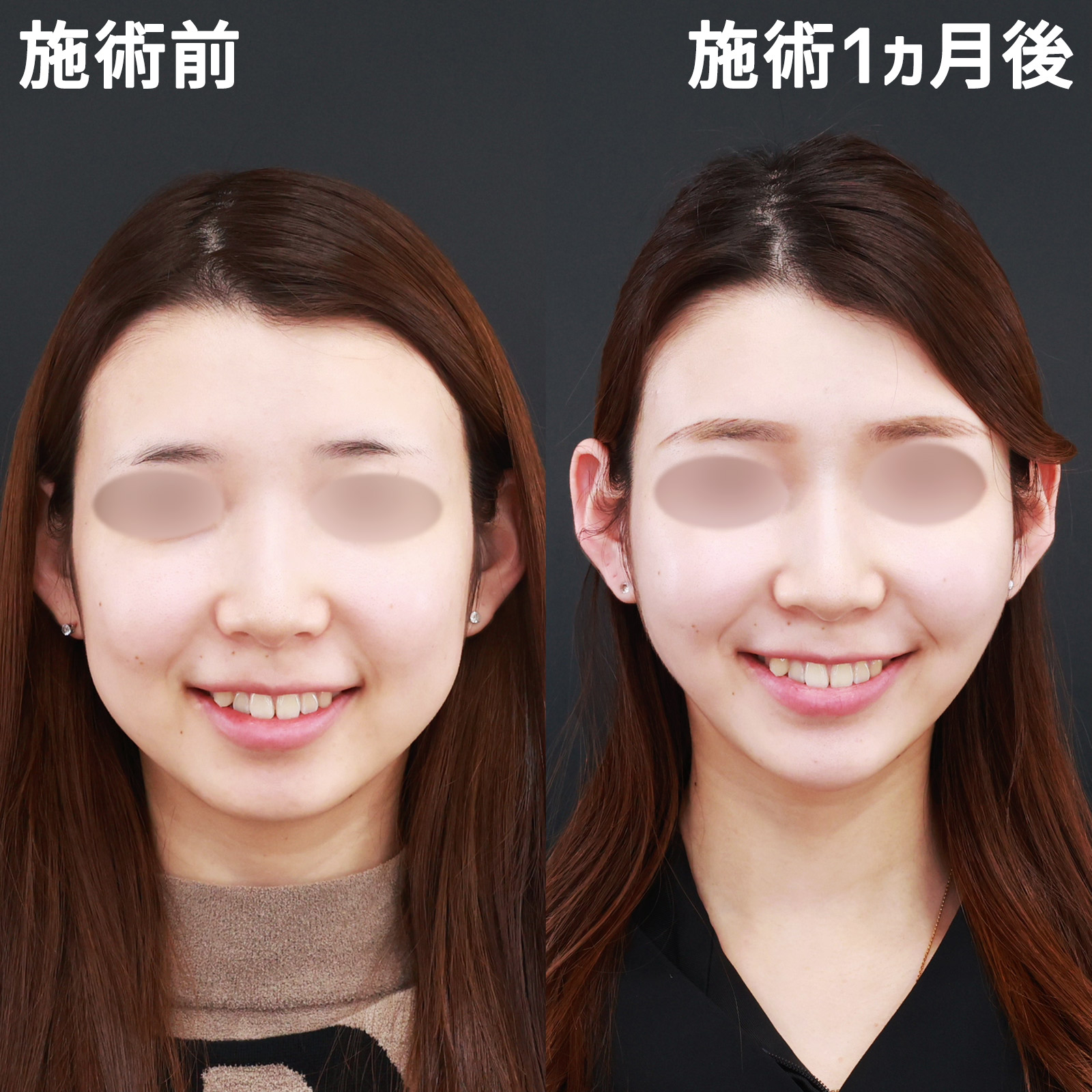 小顔整形｜パーフェクトフェイスライン/バッカルファット除去/TAC式 ツヤ肌コラーゲンリフト®の症例写真 施術前後 