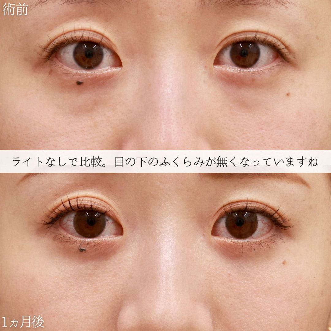 下眼瞼脱脂術（目の下のたるみ取り・目の下の脂肪ふくらみ取り）/顔の脂肪注入(コンデンスリッチフェイス)の症例写真 施術前後 