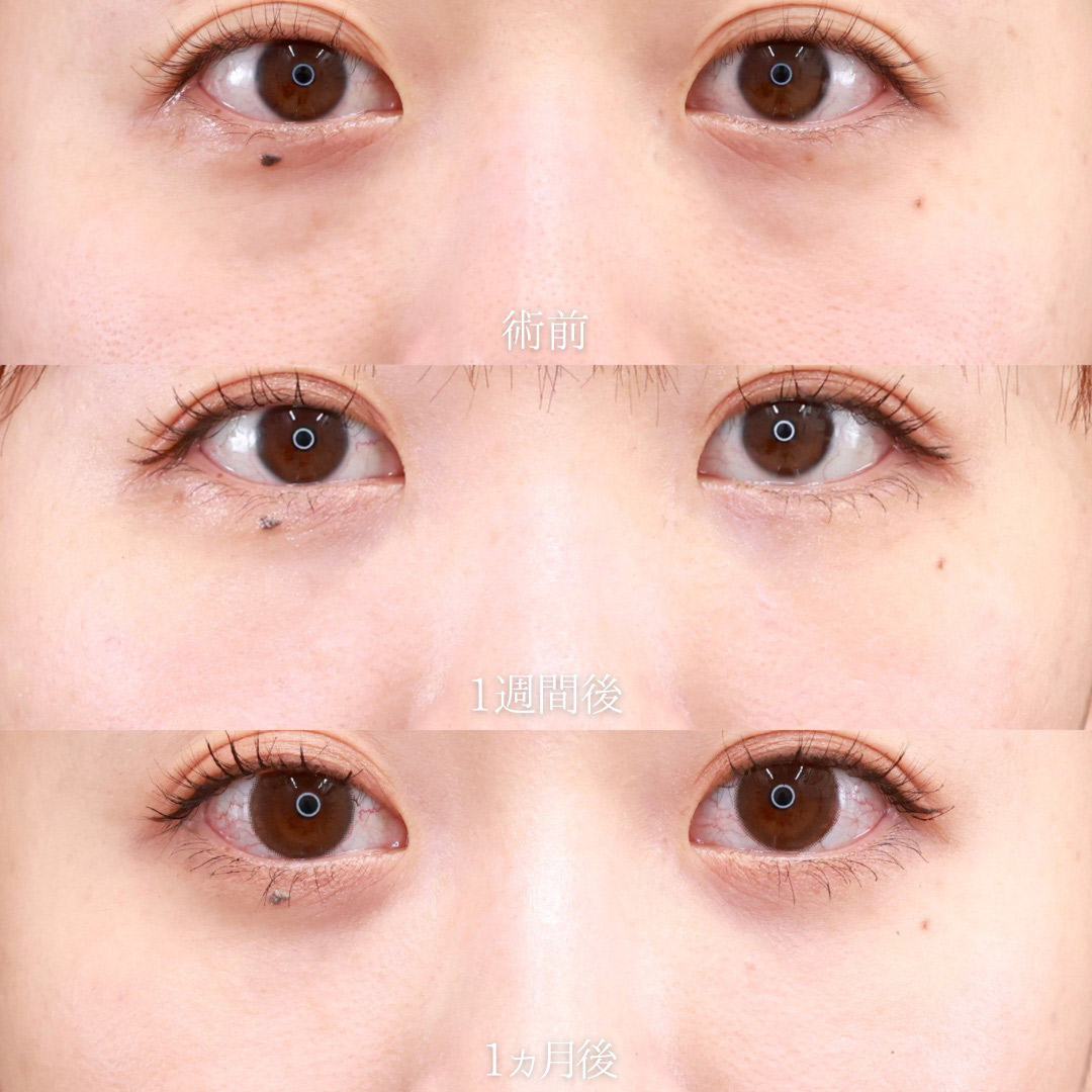 下眼瞼脱脂術（目の下のたるみ取り・目の下の脂肪ふくらみ取り）/顔の脂肪注入(コンデンスリッチフェイス)の症例写真 施術前後 
