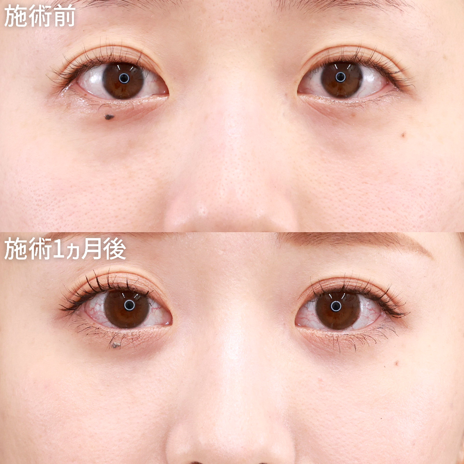 【クマ取り】目元の印象が激変！アンチエイジングにおすすめの下眼瞼脱脂術